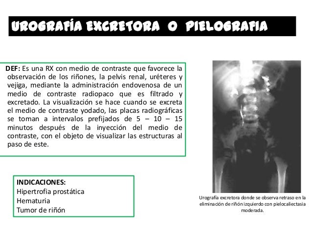 indicaciones urografia excretora